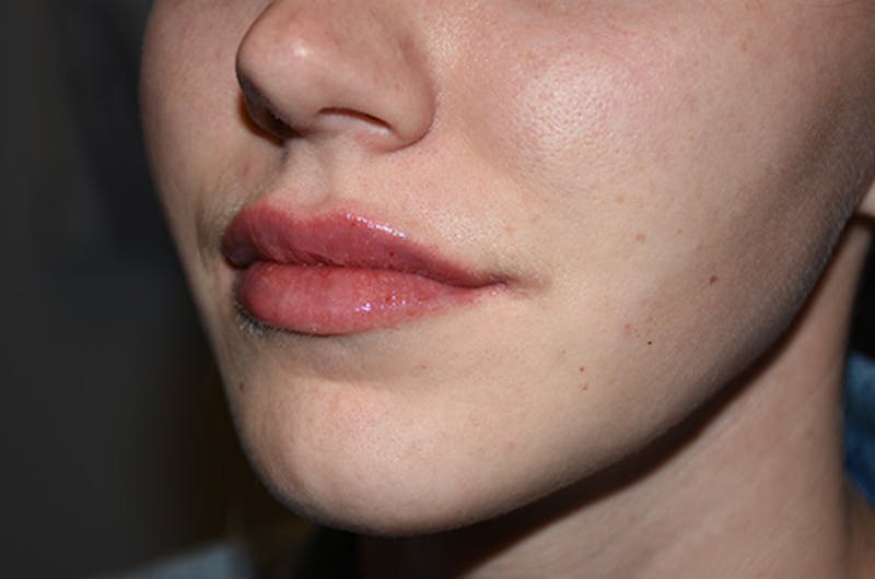Facial Fillers Before & After Gallery - Patient 109314542 - Image 6