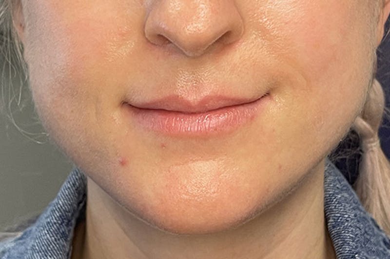 Facial Fillers Before & After Gallery - Patient 109314541 - Image 1