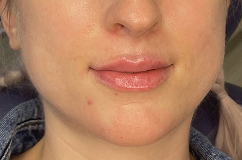 Facial Fillers Before & After Gallery - Patient 109314541 - Image 2