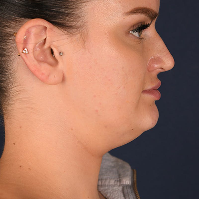 Kybella Before & After Gallery - Patient 109314548 - Image 1