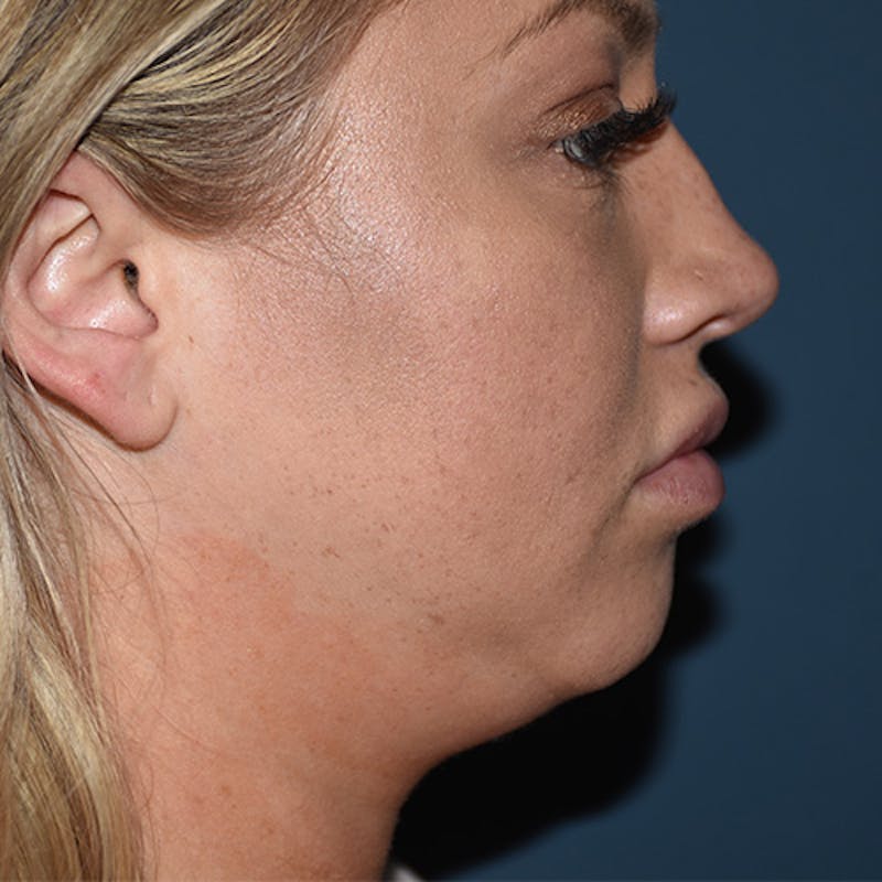 Kybella Before & After Gallery - Patient 109314549 - Image 1