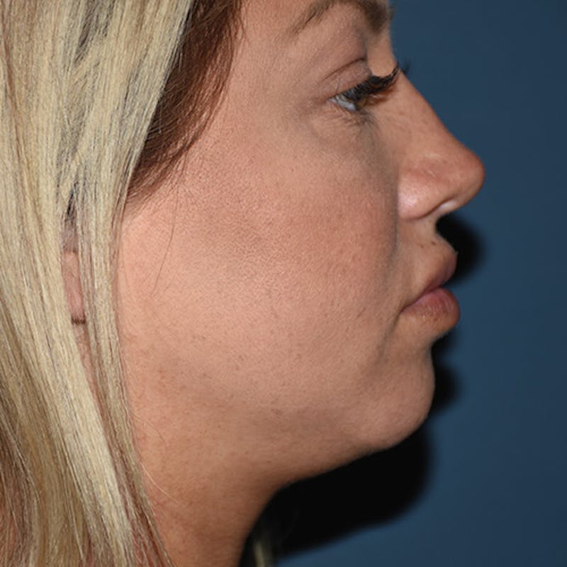 Kybella Before & After Gallery - Patient 109314549 - Image 2