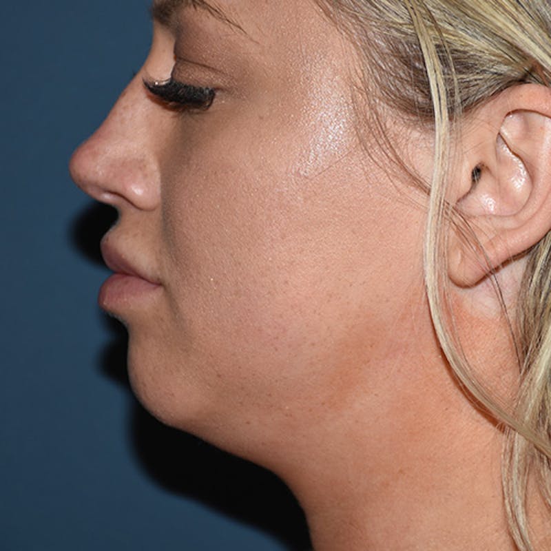 Kybella Before & After Gallery - Patient 109314549 - Image 3