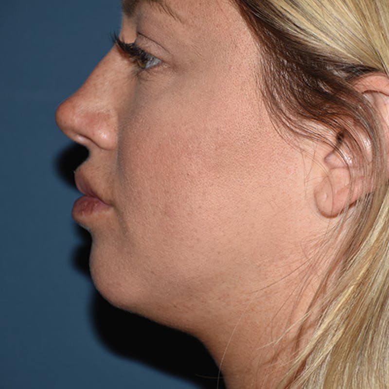 Kybella Before & After Gallery - Patient 109314549 - Image 4