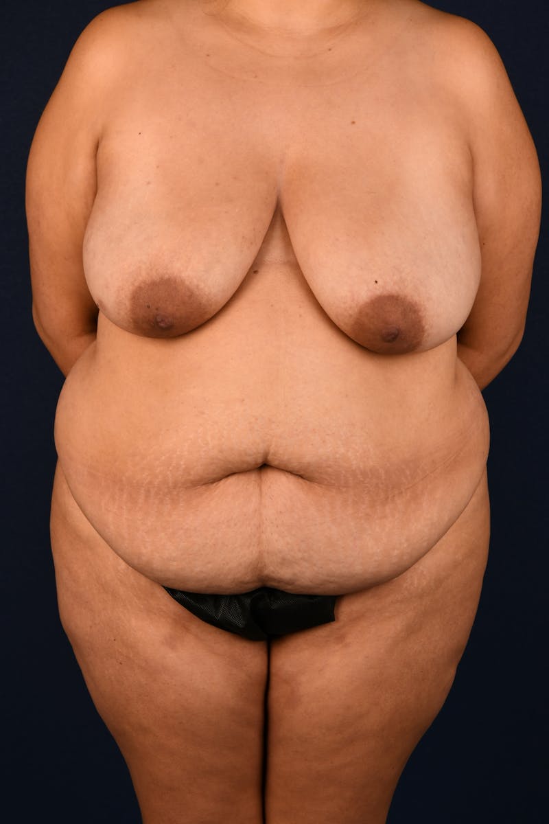 Extreme Body Contouring Before & After Gallery - Patient 111474363 - Image 1