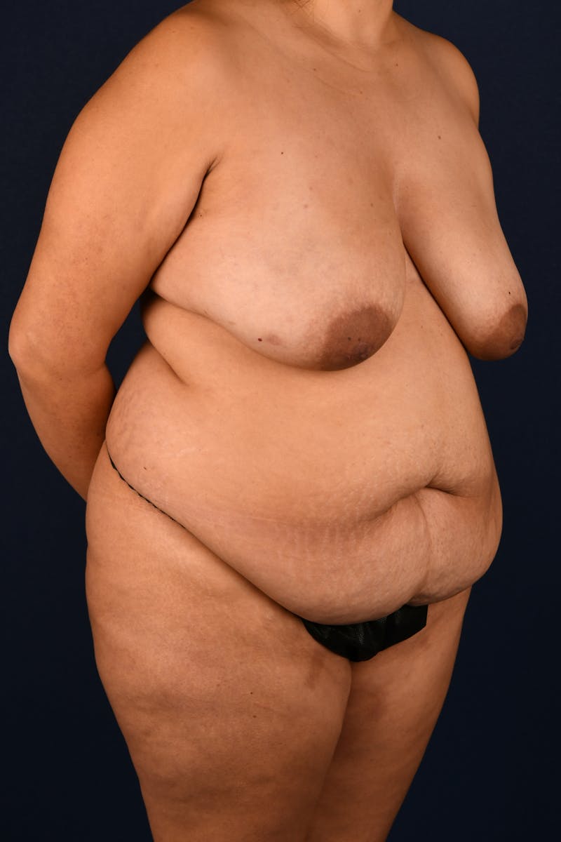 Extreme Body Contouring Before & After Gallery - Patient 111474363 - Image 3