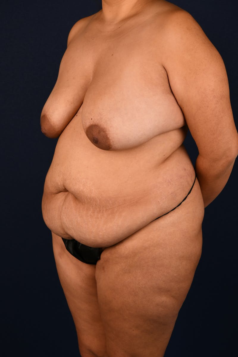 Extreme Body Contouring Before & After Gallery - Patient 111474363 - Image 5