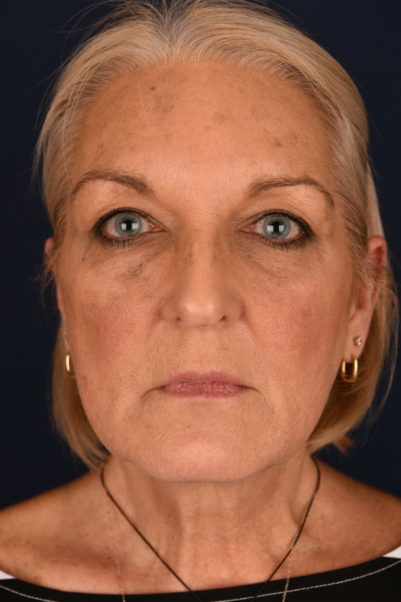 Facelift Before & After Gallery - Patient 211637 - Image 1