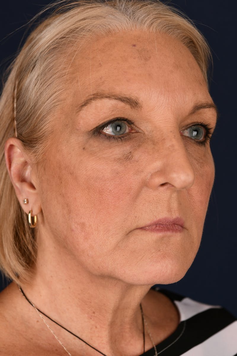 Facelift Before & After Gallery - Patient 211637 - Image 3