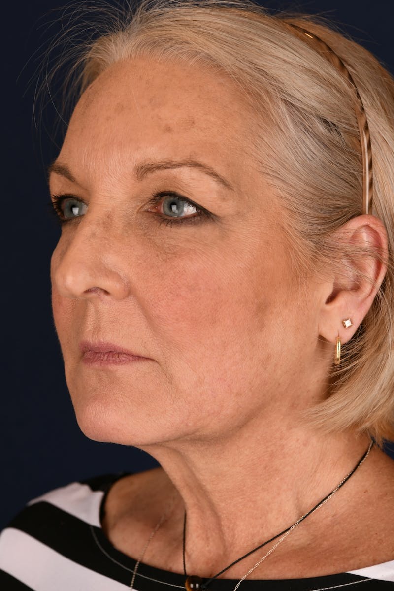 Facelift Before & After Gallery - Patient 211637 - Image 5