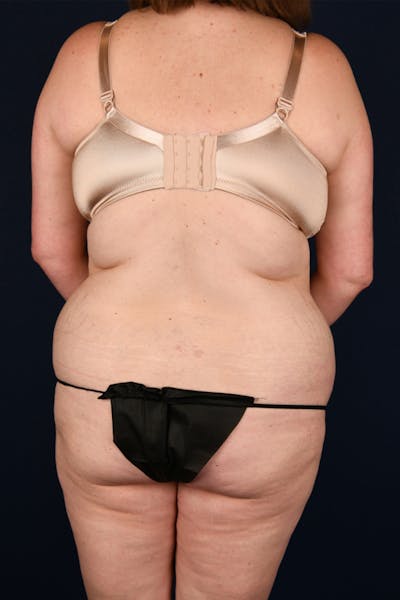 Lower Body Lift Before & After Gallery - Patient 603034 - Image 1
