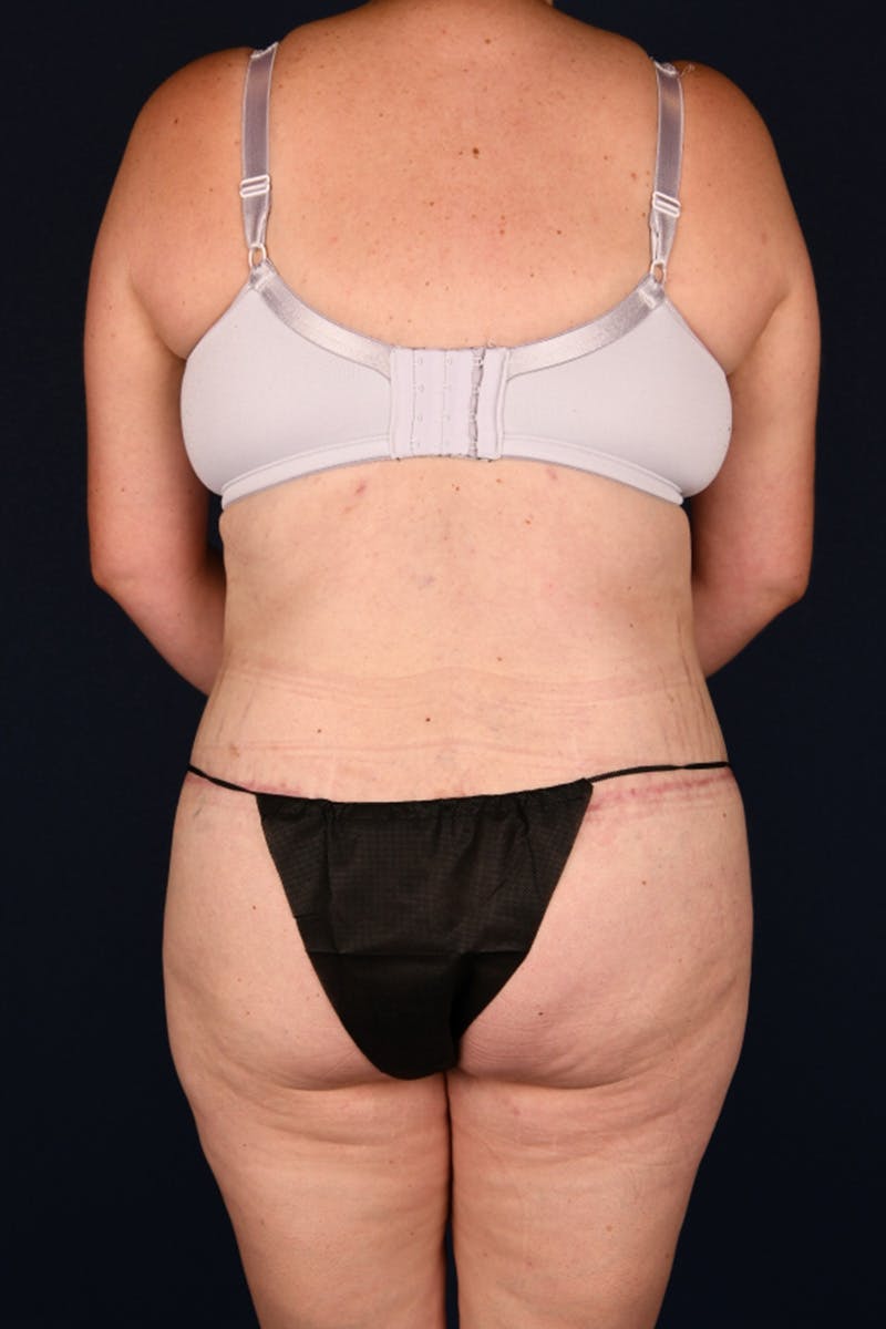 Lower Body Lift Before & After Gallery - Patient 603034 - Image 2