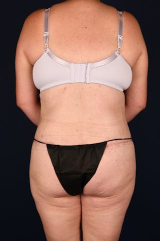 Lower Body Lift Before & After Gallery - Patient 603034 - Image 2