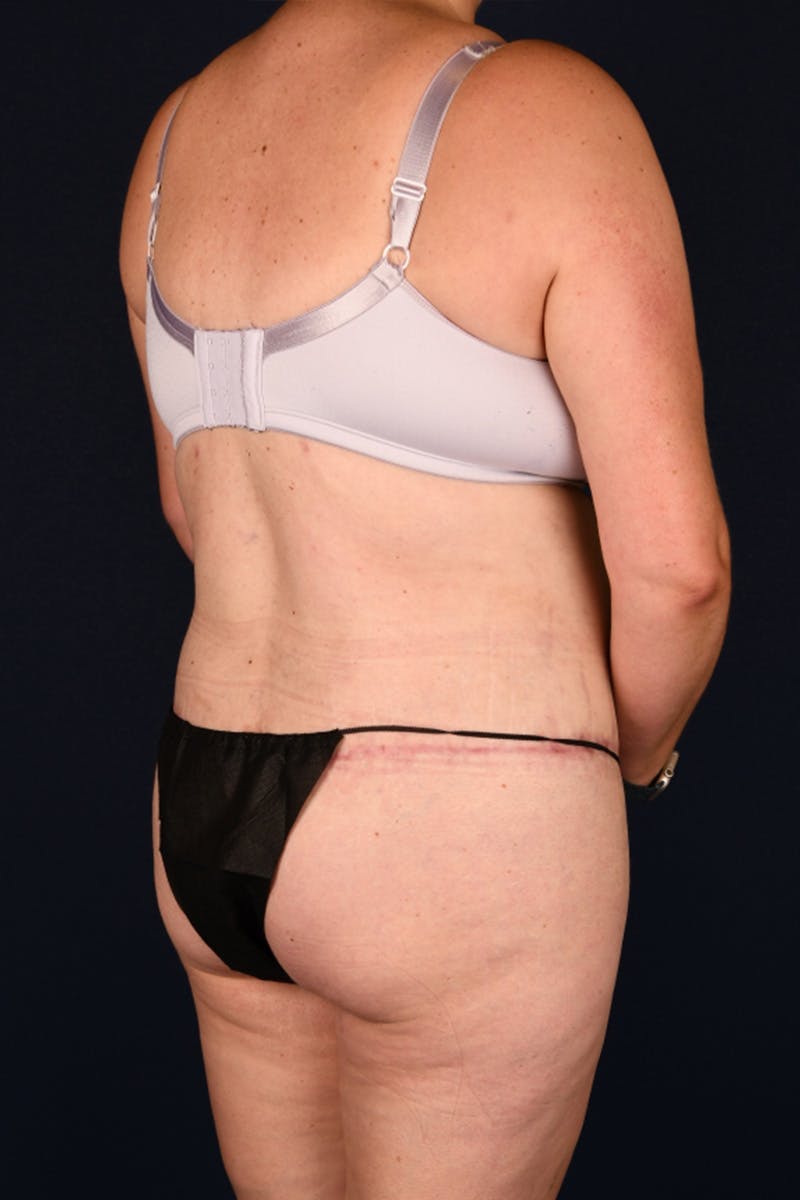 Lower Body Lift Before & After Gallery - Patient 603034 - Image 4