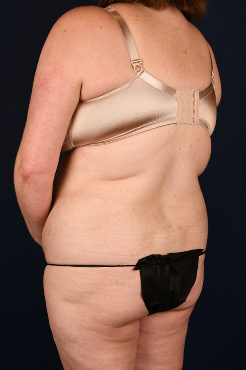 Lower Body Lift Before & After Gallery - Patient 603034 - Image 5