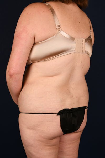 Lower Body Lift Before & After Gallery - Patient 603034 - Image 5