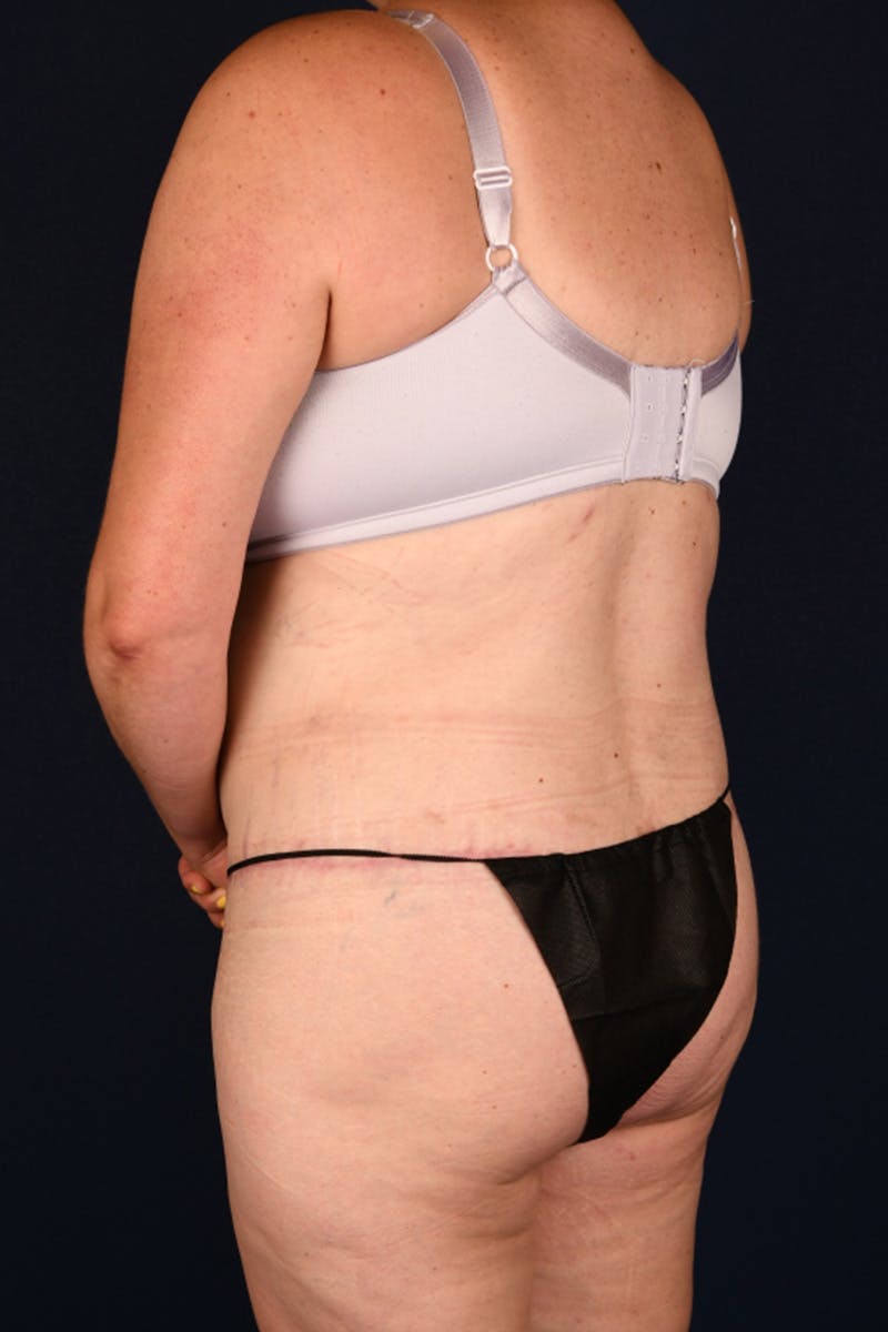 Lower Body Lift Before & After Gallery - Patient 603034 - Image 6