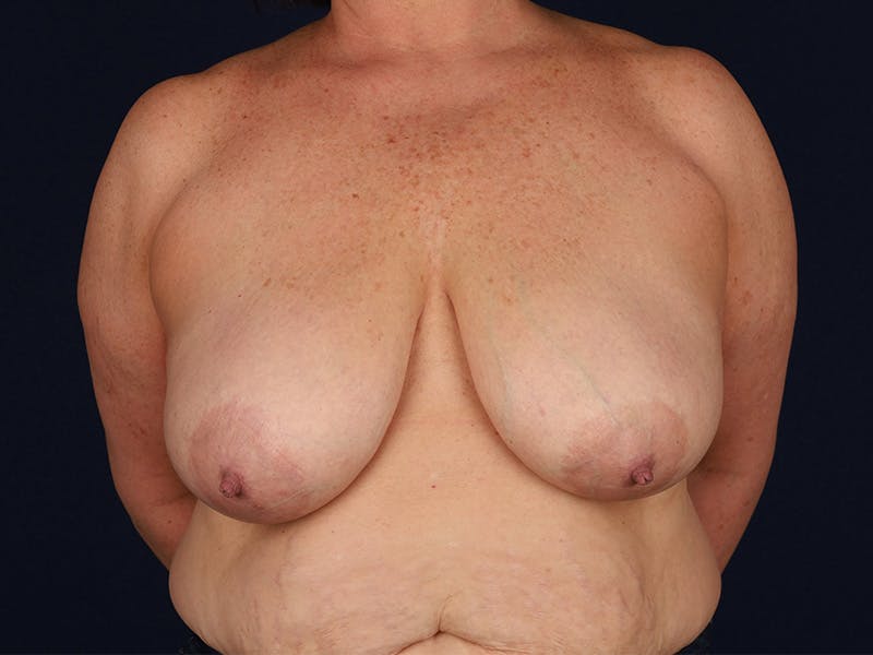 Large Augmentation Before & After Gallery - Patient 9421910 - Image 1