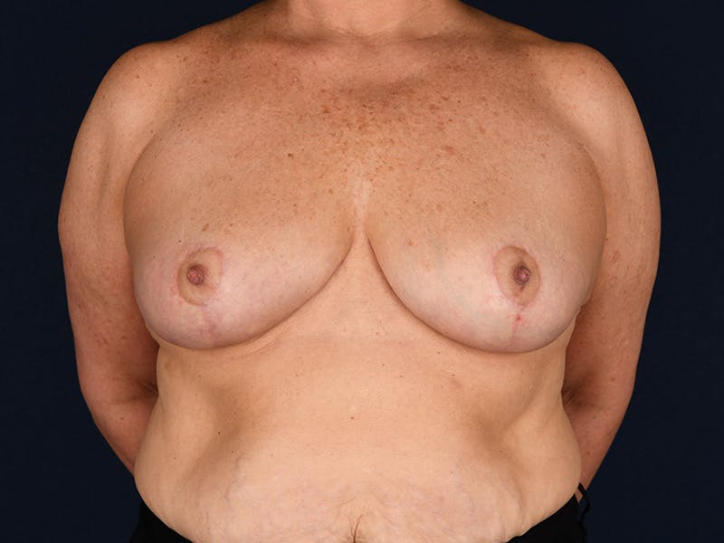 Large Augmentation Before & After Gallery - Patient 9421910 - Image 2