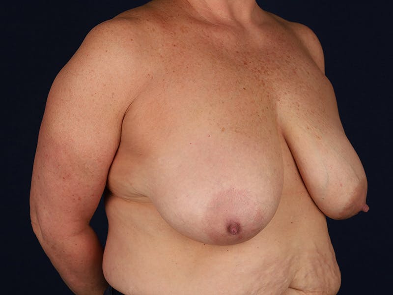 Large Augmentation Before & After Gallery - Patient 9421910 - Image 5