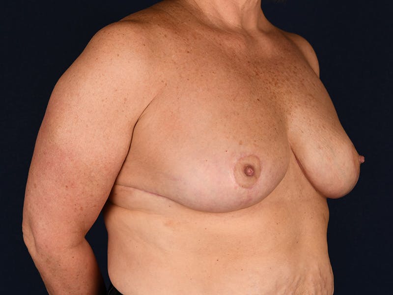Large Augmentation Before & After Gallery - Patient 9421910 - Image 6