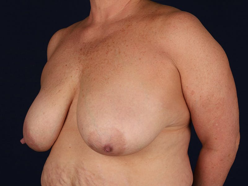 Large Augmentation Before & After Gallery - Patient 9421910 - Image 3