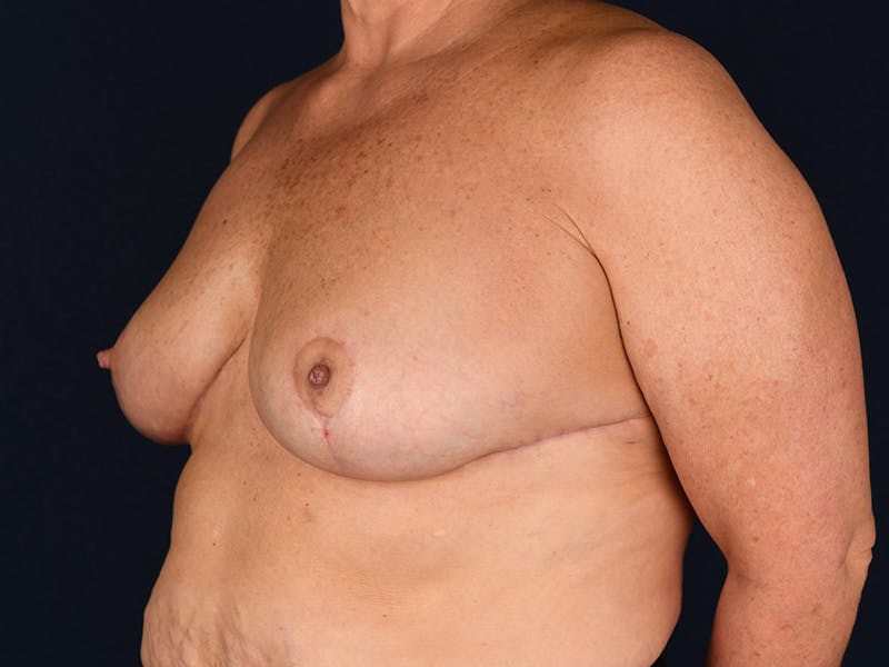 Large Augmentation Before & After Gallery - Patient 9421910 - Image 4