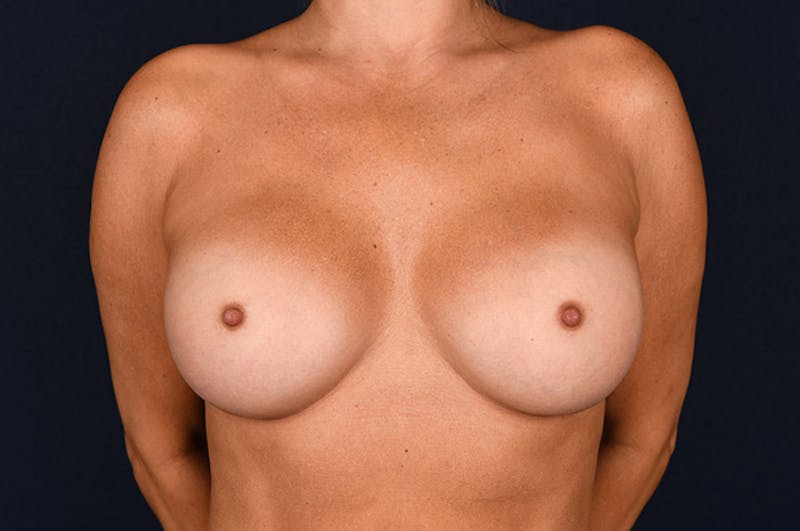 Medium Augmentation Before & After Gallery - Patient 9421913 - Image 2