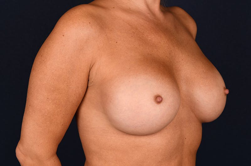 Medium Augmentation Before & After Gallery - Patient 9421913 - Image 4