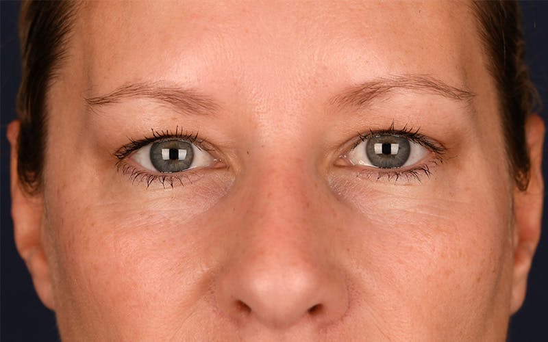 Blepharoplasty Before & After Gallery - Patient 9698246 - Image 1