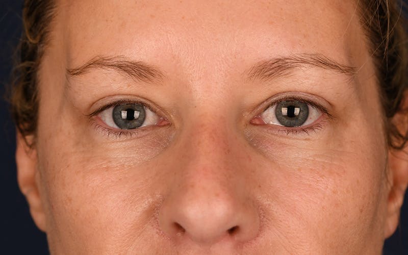 Blepharoplasty Before & After Gallery - Patient 9698246 - Image 2