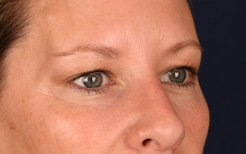 Blepharoplasty Before & After Gallery - Patient 9698246 - Image 3