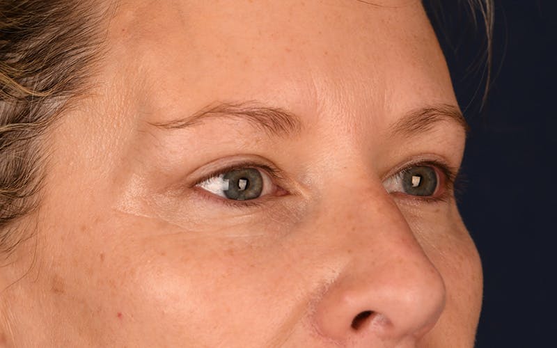 Blepharoplasty Before & After Gallery - Patient 9698246 - Image 4