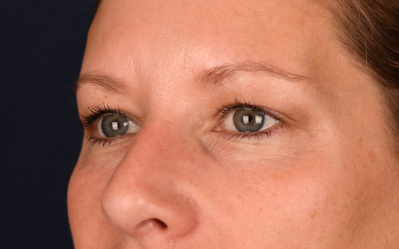 Blepharoplasty Before & After Gallery - Patient 9698246 - Image 5