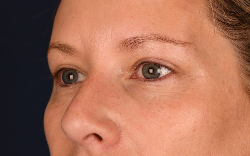 Blepharoplasty Before & After Gallery - Patient 9698246 - Image 6