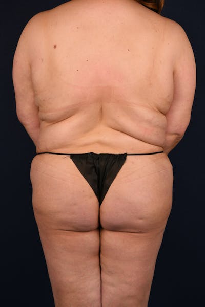 Extreme Body Contouring Before & After Gallery - Patient 126779 - Image 1