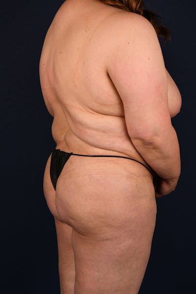 Extreme Body Contouring Before & After Gallery - Patient 126779 - Image 3