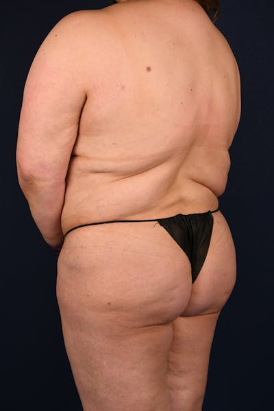 Extreme Body Contouring Before & After Gallery - Patient 126779 - Image 5