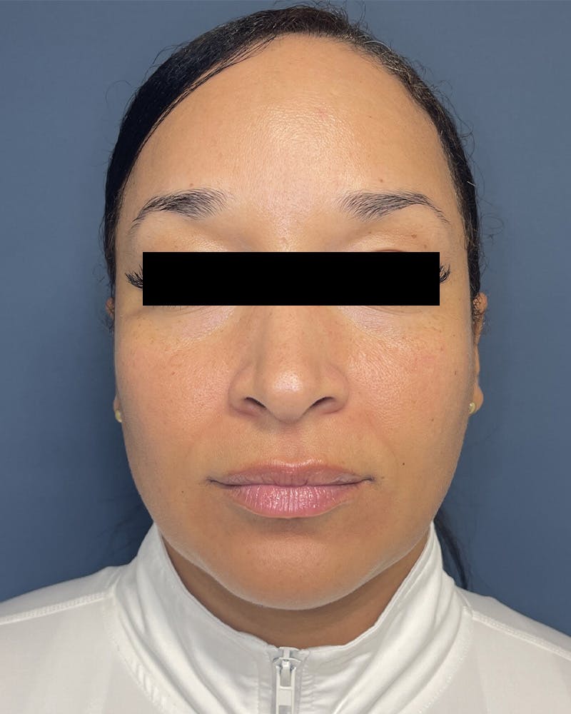 Sculptra Before & After Gallery - Patient 305321 - Image 1