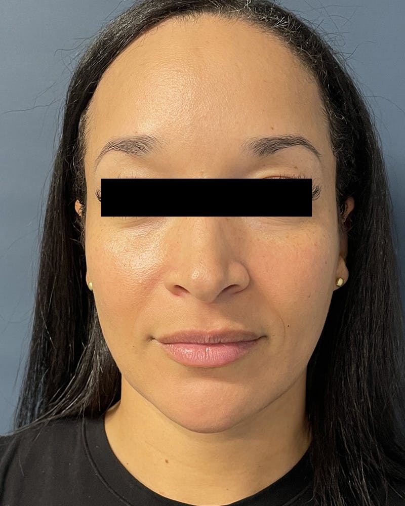 Sculptra Before & After Gallery - Patient 305321 - Image 2