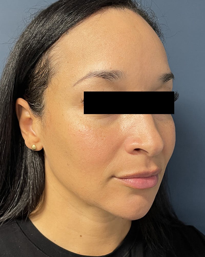 Sculptra Before & After Gallery - Patient 305321 - Image 6