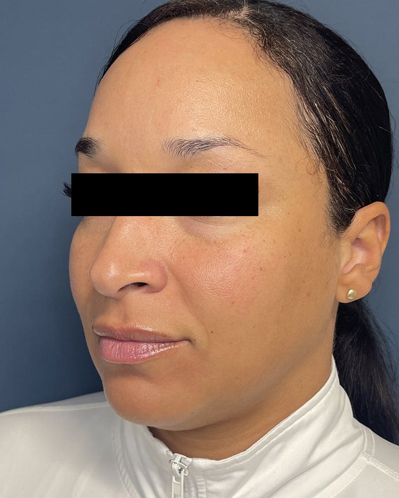 Sculptra Before & After Gallery - Patient 305321 - Image 3