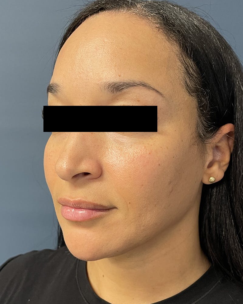 Sculptra Before & After Gallery - Patient 305321 - Image 4