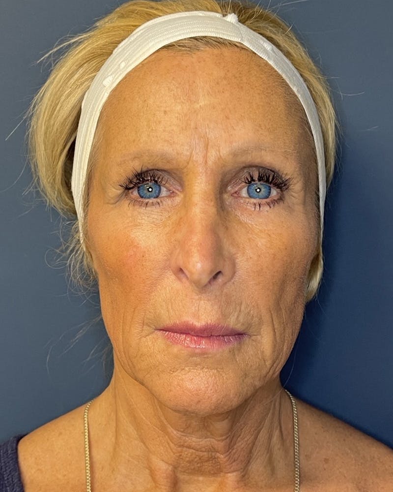 Sculptra Before & After Gallery - Patient 146296 - Image 2