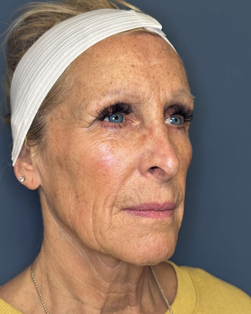 Sculptra Before & After Gallery - Patient 146296 - Image 3