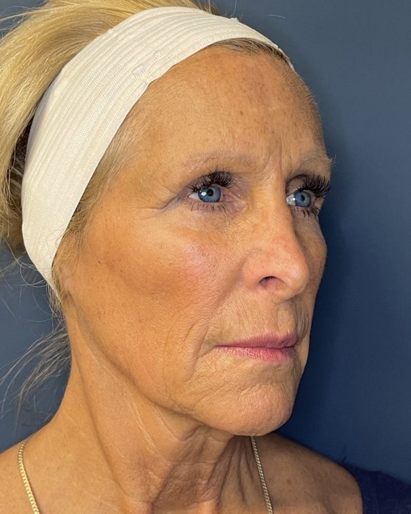Sculptra Before & After Gallery - Patient 146296 - Image 4