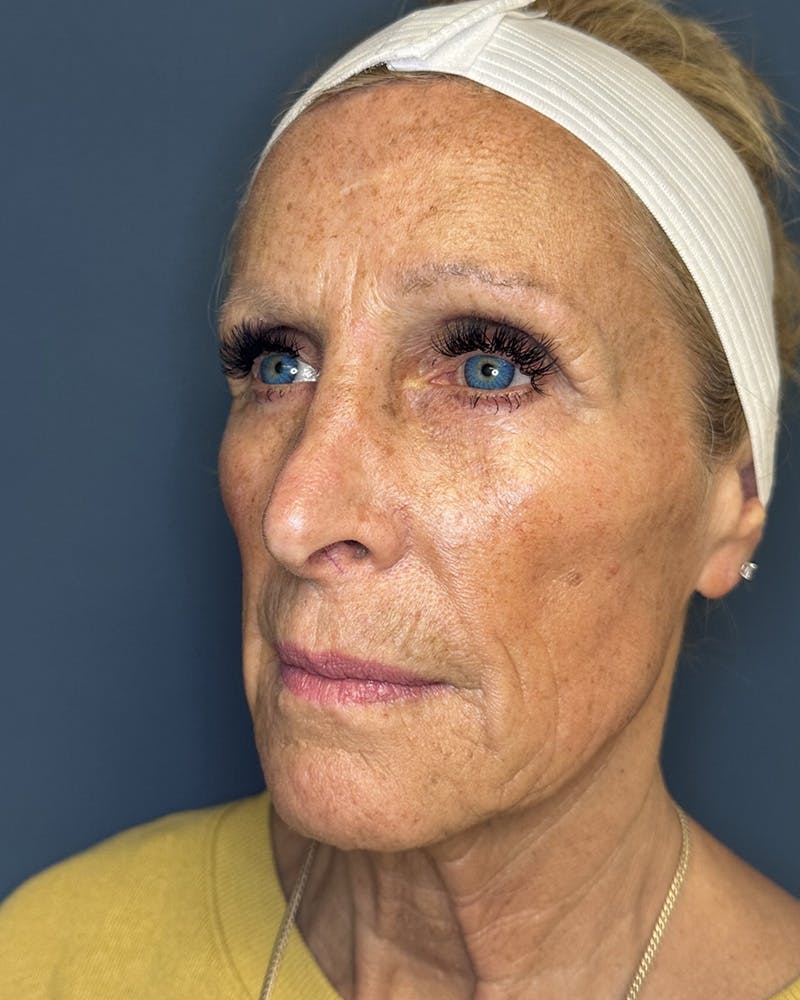Sculptra Before & After Gallery - Patient 146296 - Image 5