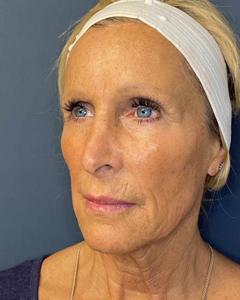 Sculptra Before & After Gallery - Patient 146296 - Image 6
