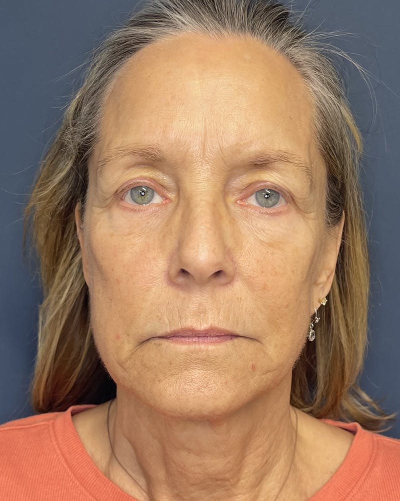Sculptra Before & After Gallery - Patient 428497 - Image 1