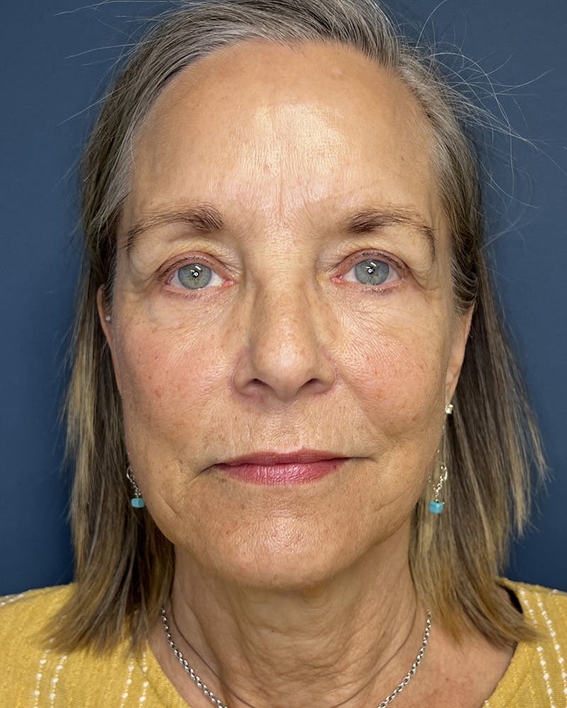 Sculptra Before & After Gallery - Patient 428497 - Image 2